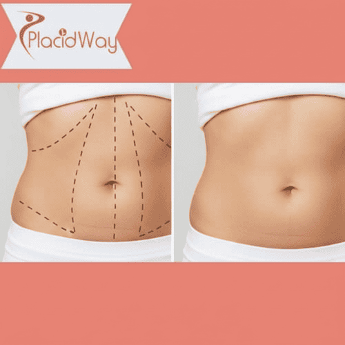 Tummy Tuck Surgery in Turkey for Adelaide Patients After Weight Loss 